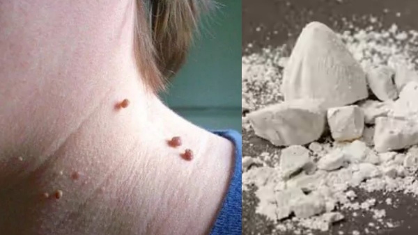 Chuna For Warts Removal