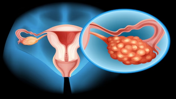 Ovarian Cancer Symptoms