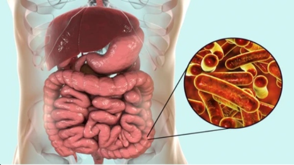 Shigella Infection
