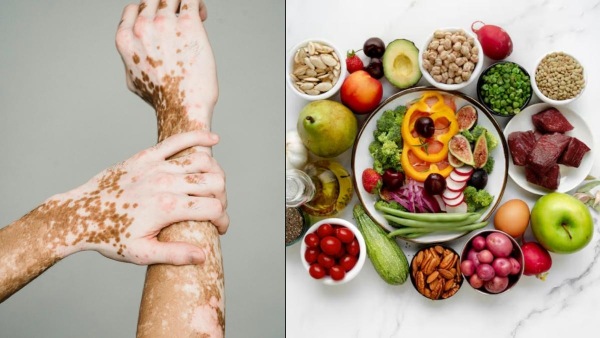 Vitiligo Diet
