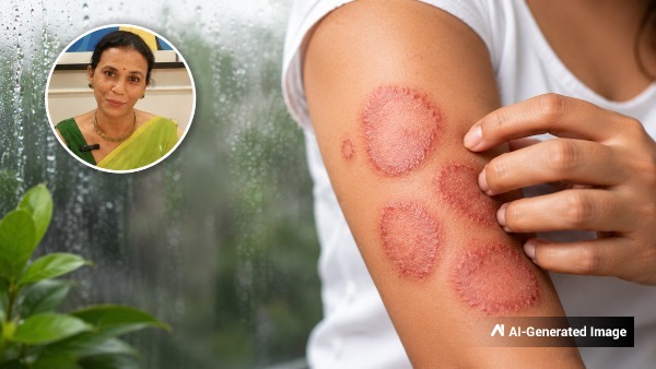 Fungal Infection In Monsoon Ayurvedic Remedies Fungal Infection In Monsoon Ayurvedic Remedies