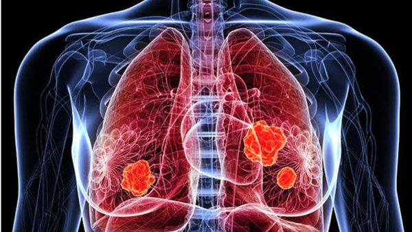 Lung Damage Symptoms