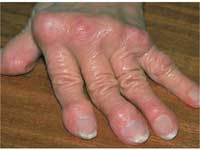 Rheumatoid Arthritis Rheumatoid Arthritis