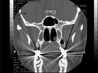 Cell Phones Cause Brain Tumors? Cell Phones Cause Brain Tumors?