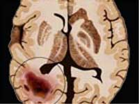 Scorpion Venom May Help Fight Brain Cancer Scorpion Venom May Help Fight Brain Cancer