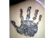 Medical tattoos Medical tattoos