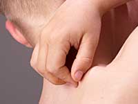 Prickly Heat Prickly Heat