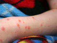 Chicken Pox Scar Chicken Pox Scar