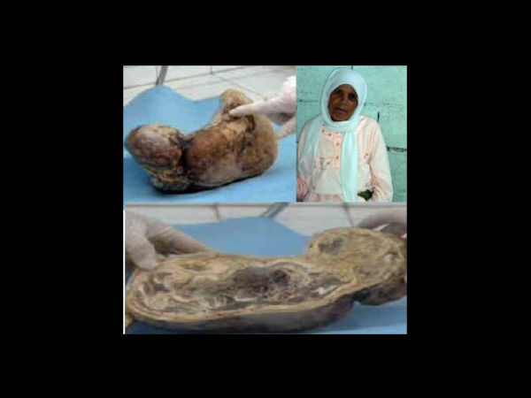 Zahra Gave Birth To A 'Stone Baby' Zahra Gave Birth To A 'Stone Baby'