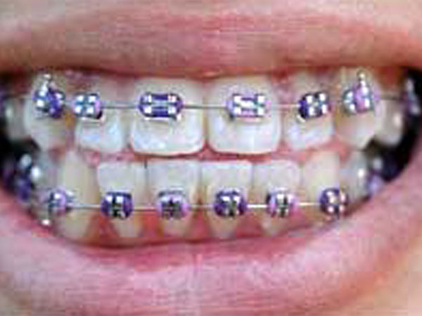 Braces Ain’t A Curse!