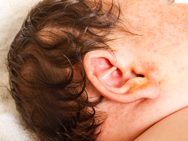 Bronchiolitis In Children