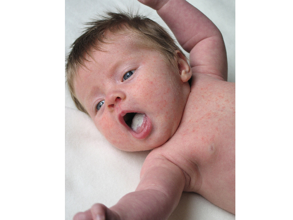 Treatment For Oral Thrush