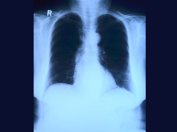 Ways To Diagnose Early Asthma In Children