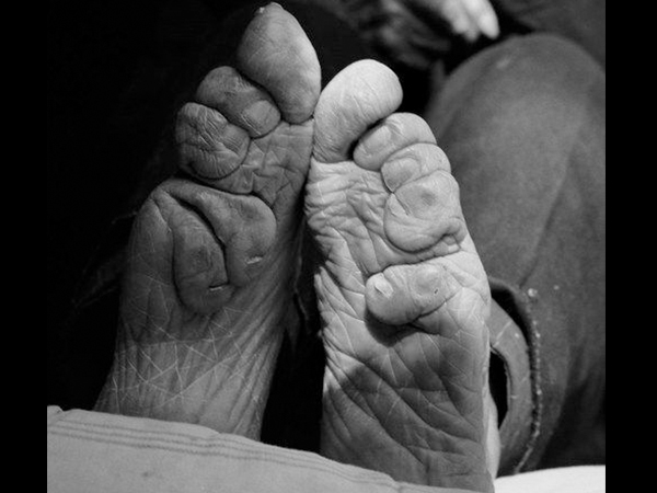 Deformation of foot because of binding