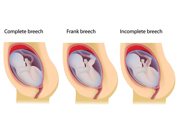 Breech Position Of Baby Breech Position Of Baby