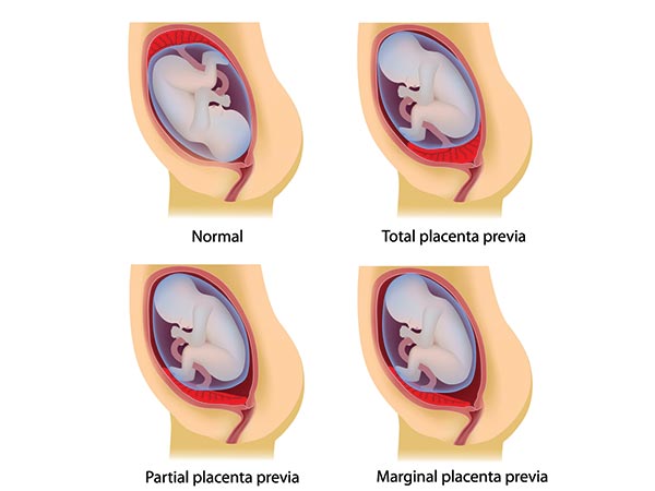 Placenta Previa: Placenta Previa: