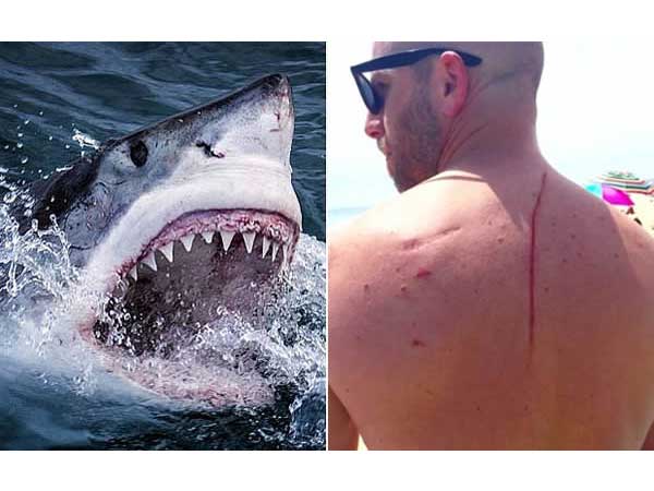 This Man Who Was Attacked By A Shark