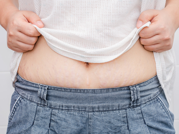 how to get rid of stretch marks naturally