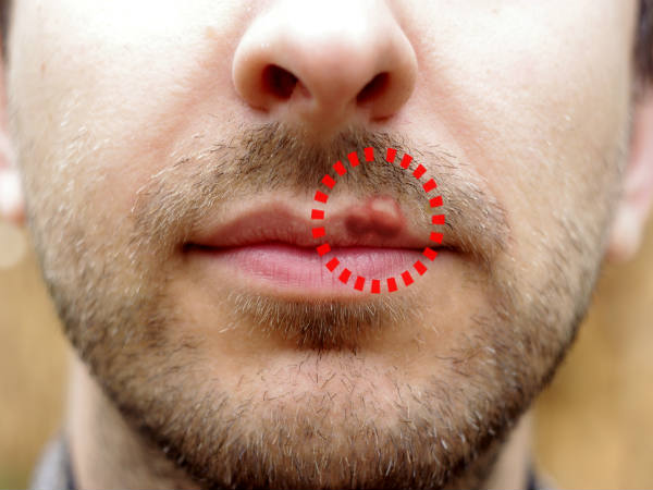 treatment for herpes treatment for herpes