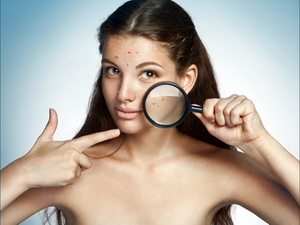 foolproof remedy for blackheads