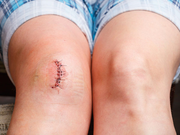 wound wound