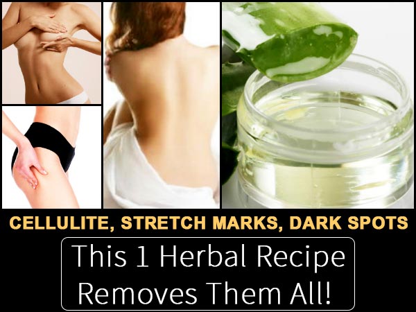 stretch marks stretch marks