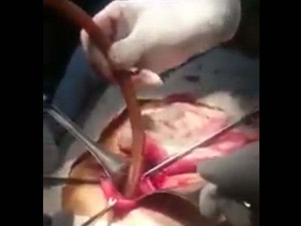 Doctors Pan In At The Incision