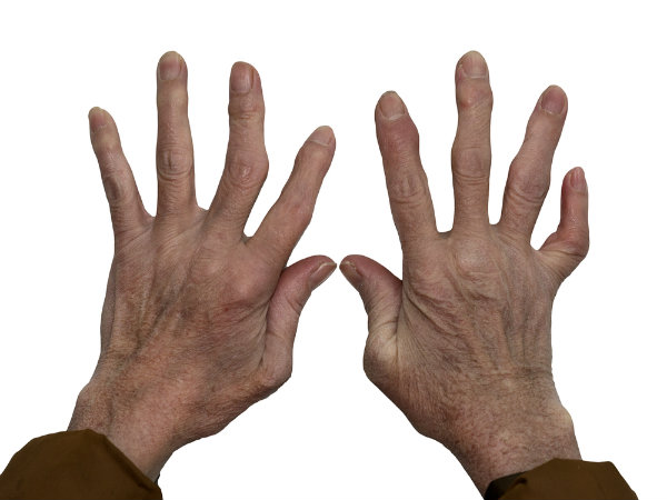 1. Rheumatoid Arthritis: