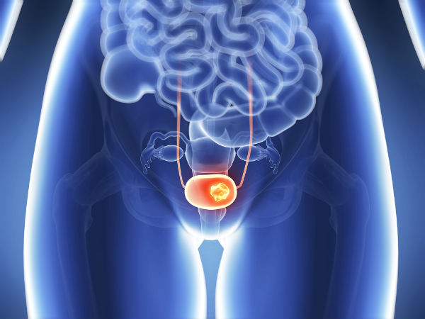 Bladder Cancer: Why Is It Dangerous? 