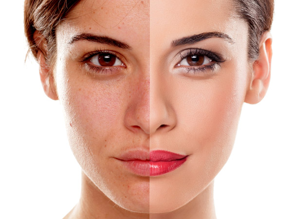 5. Treats Hyperpigmentation: