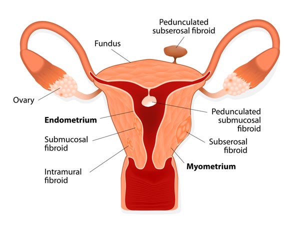 Many Women Suffer From This Condition 