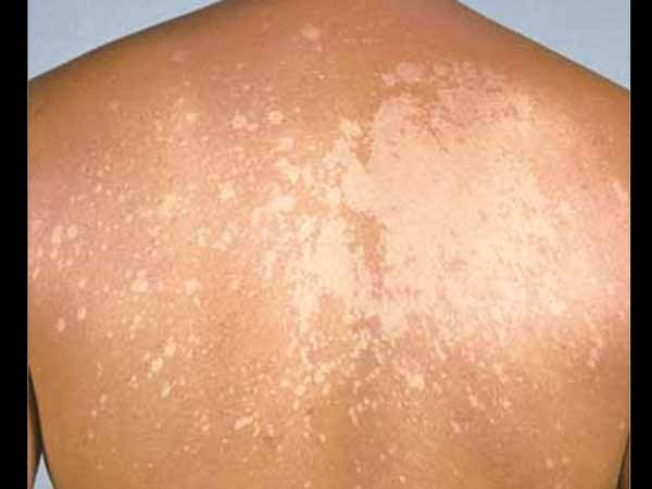 6. You Have Some Patches On Your Skin: