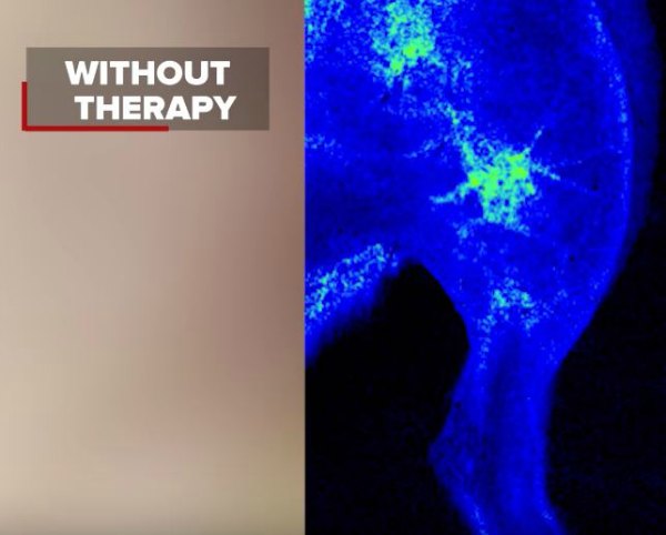 tissue nanotransfection