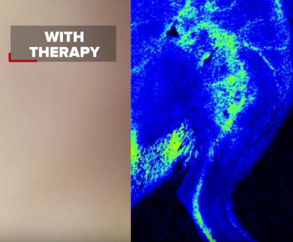 tissue nanotransfection