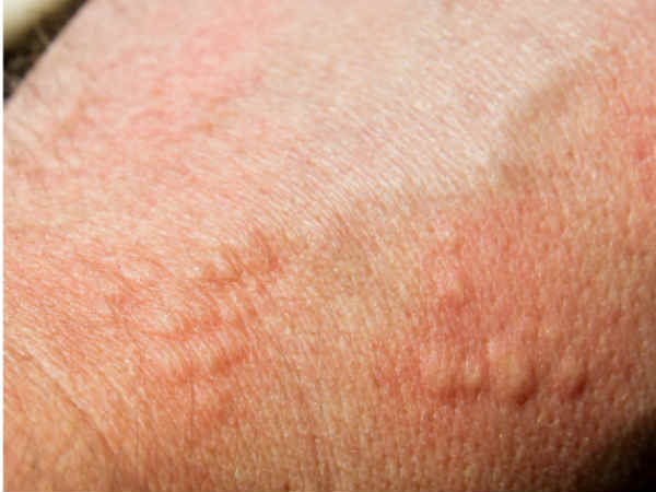 5. A Family History Of Skin Cancer: