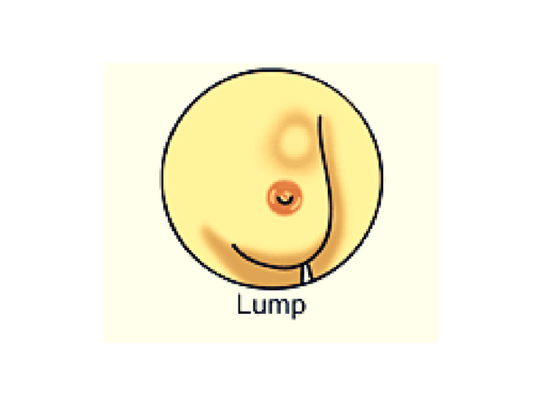 #1 Lump in Breast