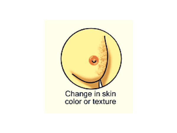 #2 Change in Texture of Your Breast