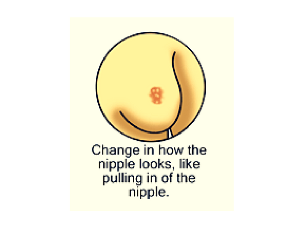 #6 Change in Nipple Texture