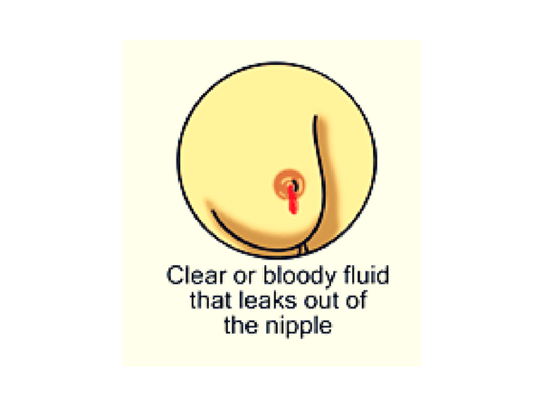 #7 White or Bloody Discharge from Nipples