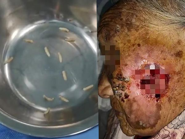 50 Maggots Removed From Human Face 50 Maggots Removed From Human Face