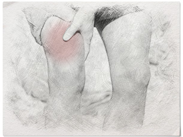 meralgia paresthetica image meralgia paresthetica image