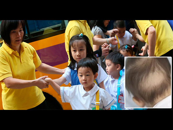 2.5 Year Old Kid Loses Hair Due To Stress 2.5 Year Old Kid Loses Hair Due To Stress