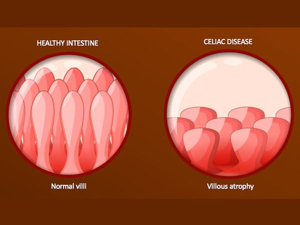 celiac Disease