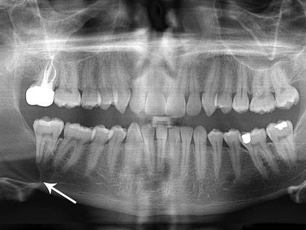Abscessed Tooth