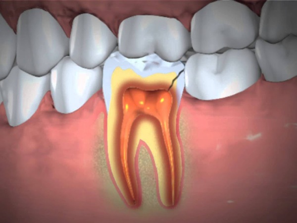 Abscessed Tooth