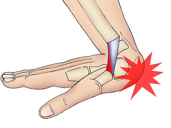 Sprained Wrist: Types, Symptoms And Treatment 