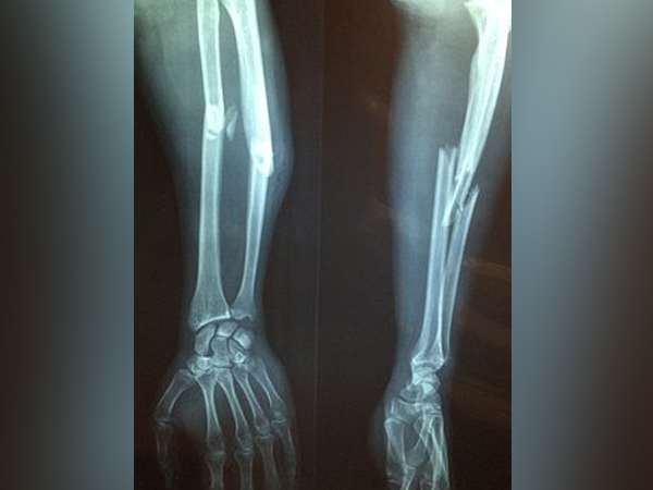 Compartment Syndrome
