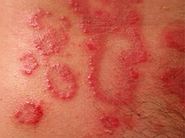 Sebopsoriasis