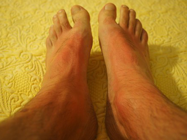 Sebopsoriasis