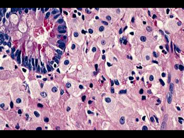Whipple Disease Whipple Disease